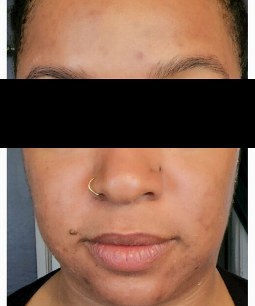 Lilac + Flint Before and After Photos | After Treatment Client 2
