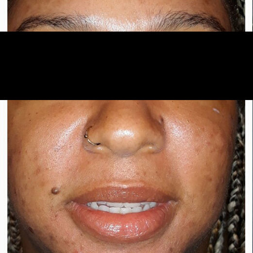 Lilac + Flint Before and After Photos | Before Treatment Client 2
