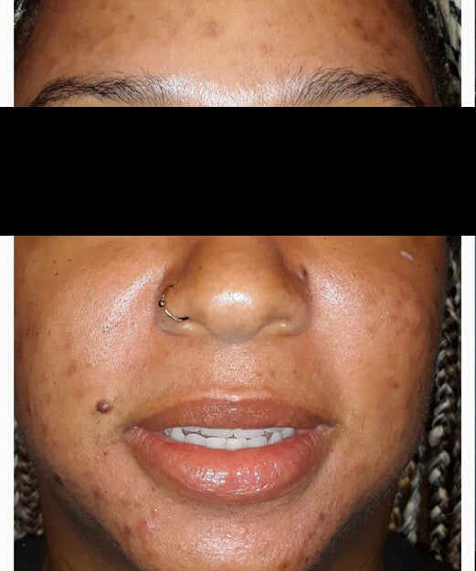 Lilac + Flint Before and After Photos | Before Treatment Client 2