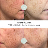 VISO - Anti-Aging Red Light Mask